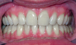 After: Patient with an overbite