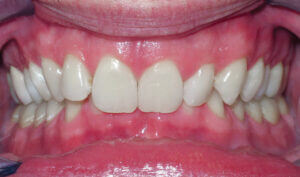 Before: Patient with an overbite