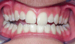 Before: Patient with an openbite