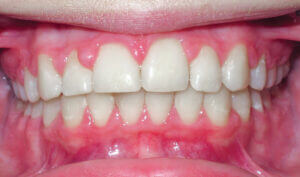After: Patient with an overbite, spacing and protrusion