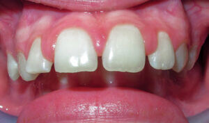 Before: Patient with an overbite, spacing and protrusion
