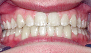 After: Patient with an overbite, spacing and protrusion