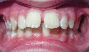 Before: Patient with an overbite, spacing and protrusion