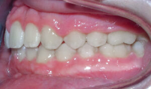 After: Patient with an overbite and protrusion