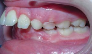 Before: Patient with an overbite and protrusion