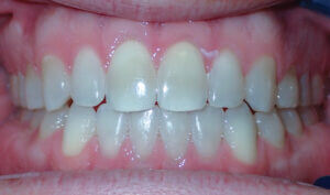 After: Patient with spacing and an anterior openbite