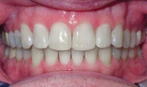 After: Patient with an overbite