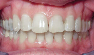 Before: Patient with an overbite
